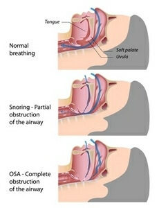 airway obstruction sleep apnea